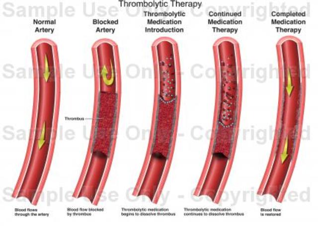 Thrombolytic Treatment was first used to unclog veines of a heartattack patient,