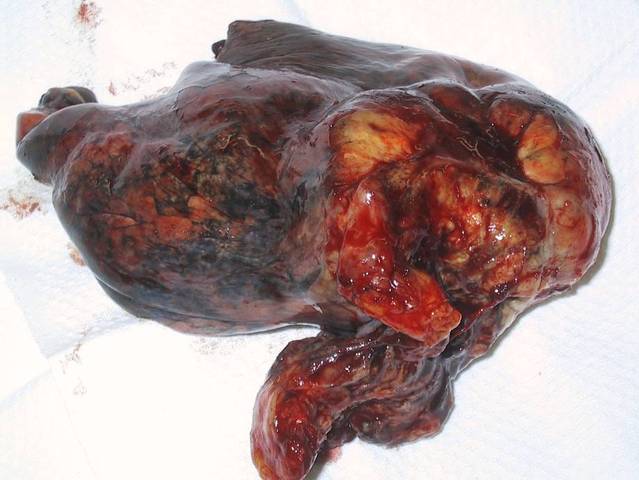 Epidemiology studies identified cigarette smoking as cause for lung cancer