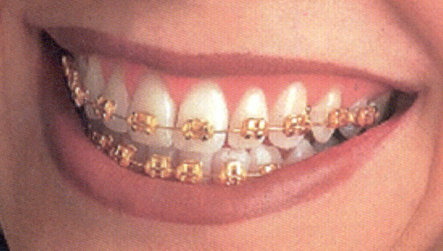 I got bottom braces
