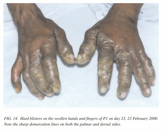 Samut Prakan radiation accident