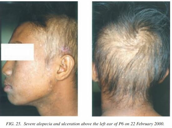 Samut Prakan radiation accident