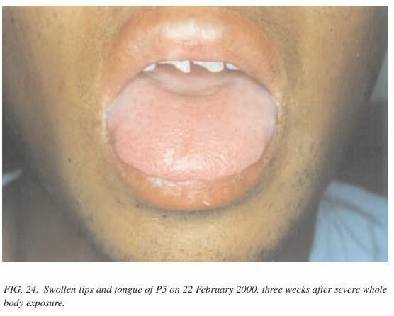 Samut Prakan radiation accident