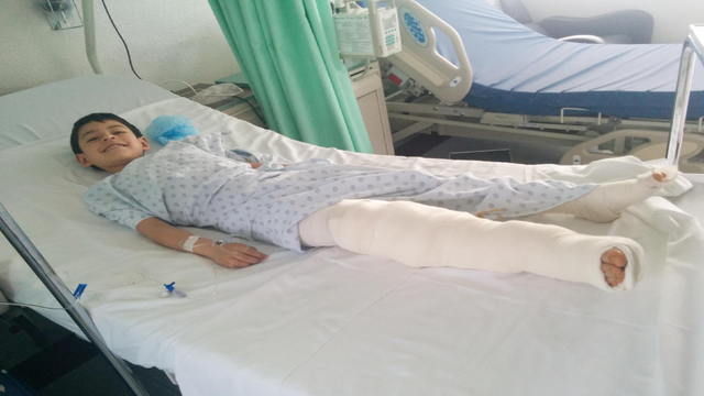 Se fracturo la pierna