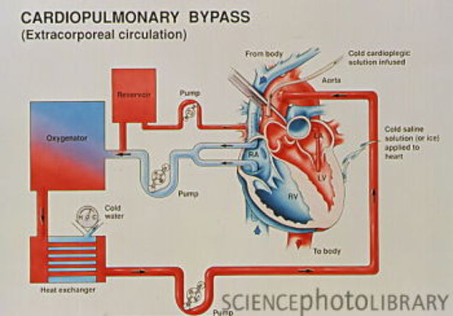 Heart-Lung Machine