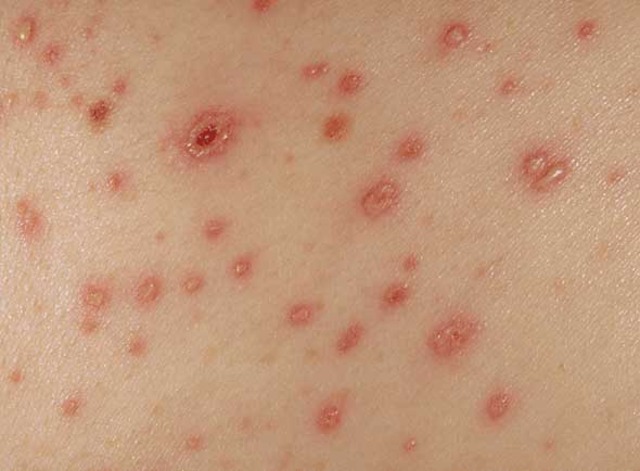 First vaccine developed for chicken pox