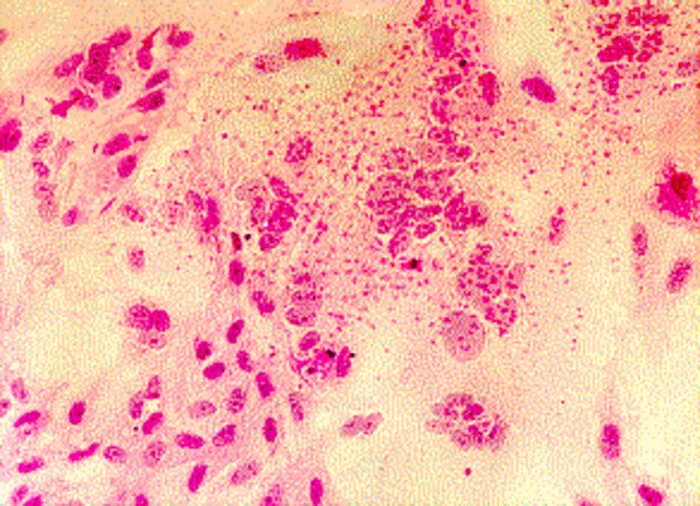 First vaccine developed for mumps