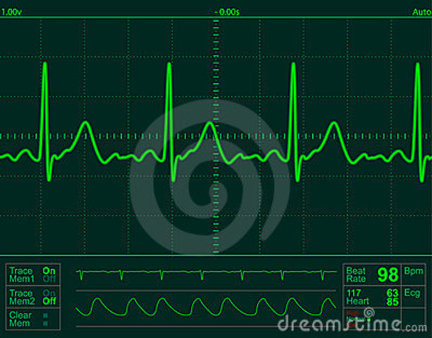 he first wireless EKG Heart rate monitor was invented