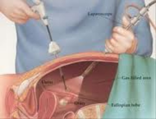 First Laparoscopic Surgery