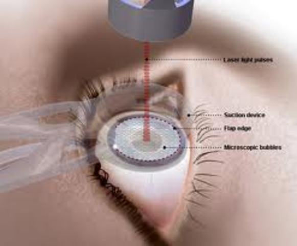 laser eye surgery
