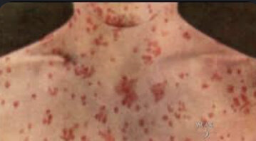 Measles