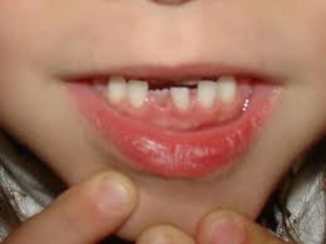 Lost my first tooth