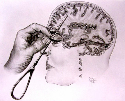 The First Lobotomy