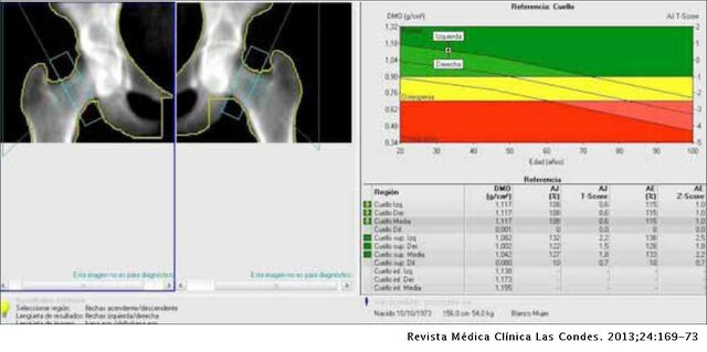 Densitometría ósea