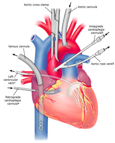 Bypass cardiopulmonar