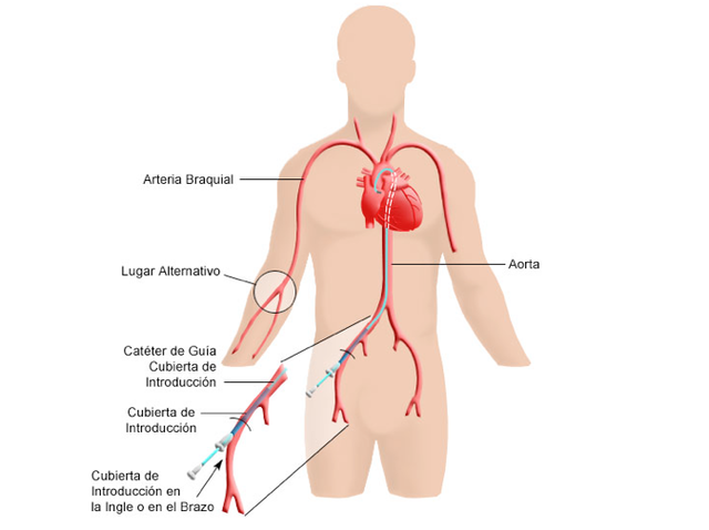 Cateterismo cardíaco