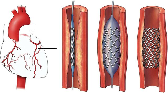 Stent coronario endovascular indígena