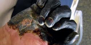 Madagascar Brot de la peste negra