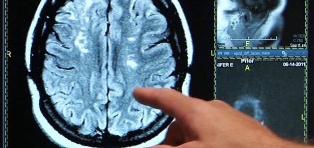 2021: La IA permite calcular el riesgo de sufrir un accidente cardiovascular