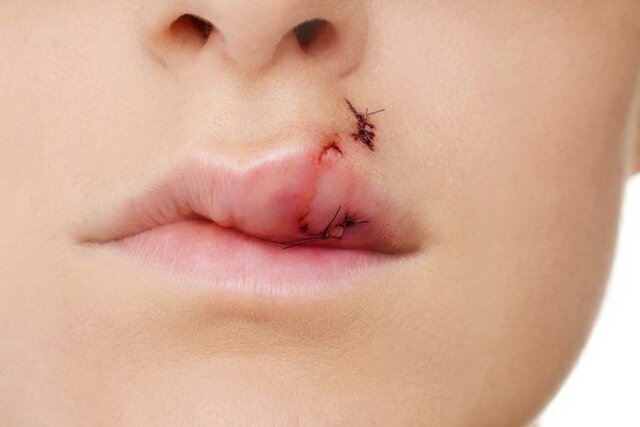 ACCIDENTE EN LA SECUNDARIA