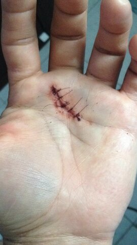 Resección de nódulos