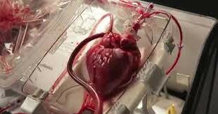 1982 implante de corazón artificial