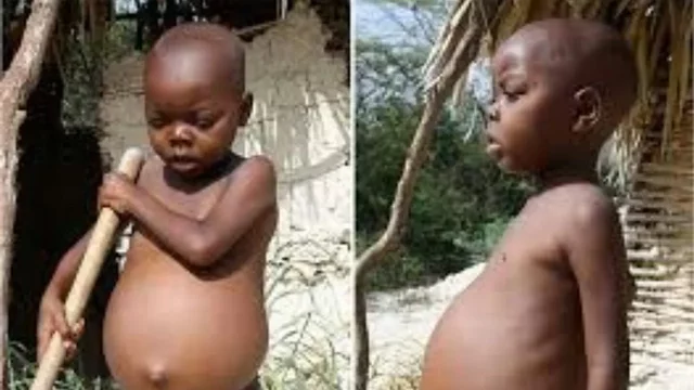 Descubrimiento del Kwashiorkor