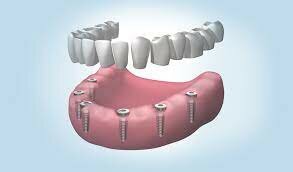 IMPLANTS DENTALS