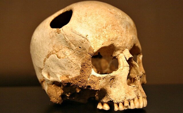 Trepanación ( 2690 - 2610 a.C)