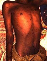 Epidemia de sampión, parotiditis en México