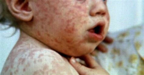 Measles Epidemic