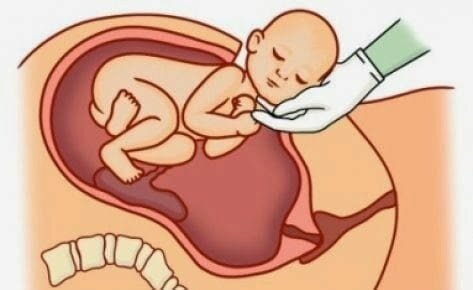 Inducción prematura