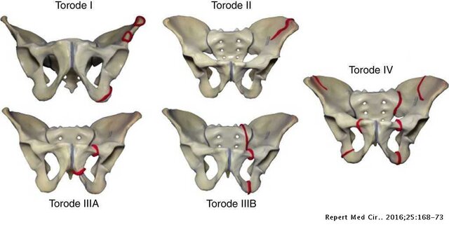 Deformidades de la pelvis