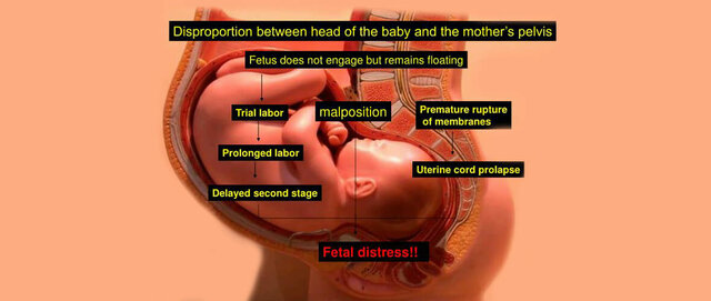 Desproporción feto pélvica