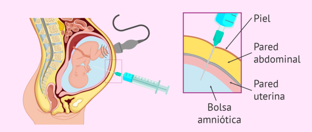 Primera amniocentesis fetal