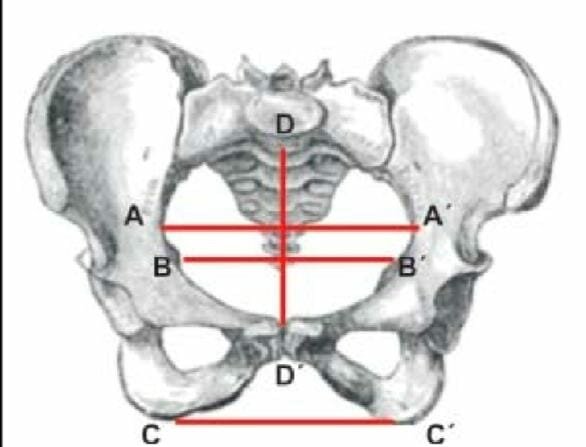 Diámetro Pélvico