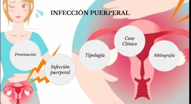 Infección Puerperal