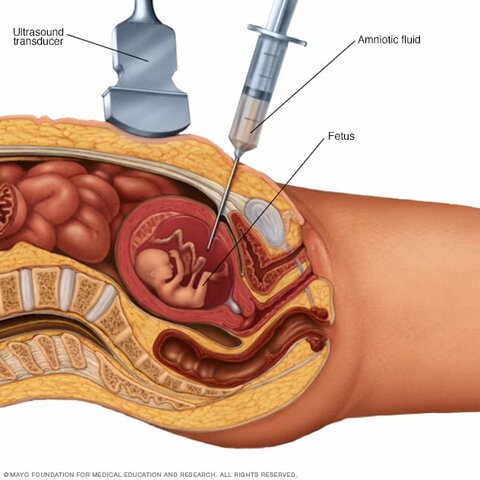 Amniocentesis fetal.
