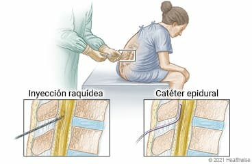 Anestesia epidural
