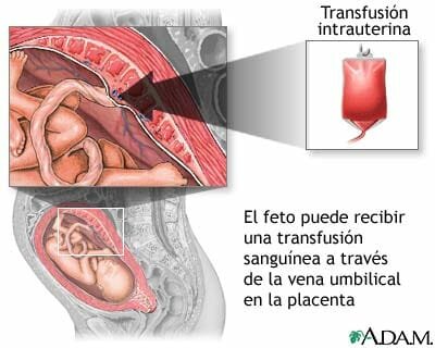Transfusiones