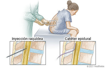 Anestesia epidural