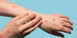 Guerra contra la viruela