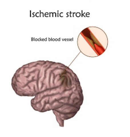 Complications/Life Changing