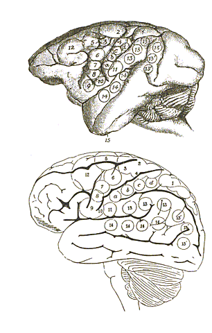 Cirugía de epilepsia