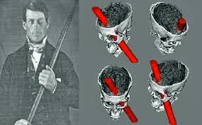 Reconstrucción por ordenado caso de Phineas Gage.