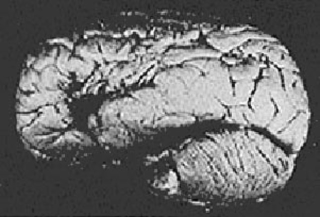 Cortical Lateralization and Localization: The Beginning of Neuropsychology