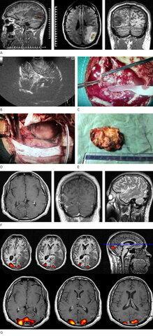 La TC se utiliza para detectar un tumor cerebral por primera vez.