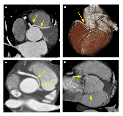 La TC se utiliza para detectar la enfermedad coronaria.