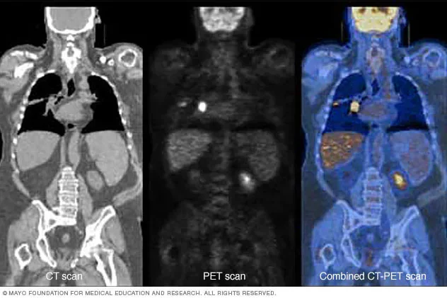Se desarrolla la TC de emisión de positrones (PET/CT), que combina la información de la TC y PET para proporcionar imágenes más precisas y detalladas de la estructura y función del cuerpo.
