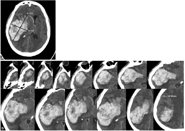 Se presenta la TC de 64 cortes, que permite la adquisición de imágenes en alta resolución en un corto período de tiempo.