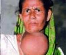 Primer programa de iodación de la sal